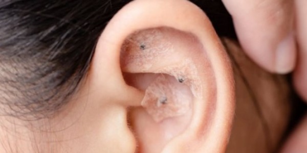 Akupuntur Telinga Bisa Turunkan Berat Badan, Yuk Coba Sekarang