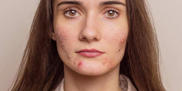 5 Tips Mencegah Jerawat, Rutin Membersihkan Wajah hingga Pakai Sunscreen